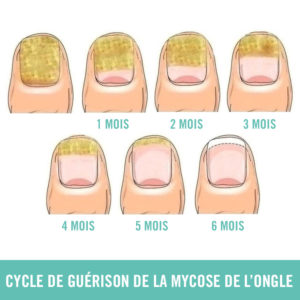 Traitement anti-mycose de l'ongle Sephorris 10 ml - CURE 6 MOIS – Image 5